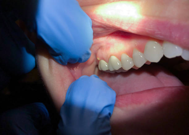 Best Emergency Treatment for Dental Infections or Abscesses in Mentor, OH